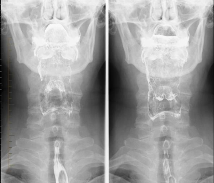 HSG, Barium Meal, Barium Swallow Test